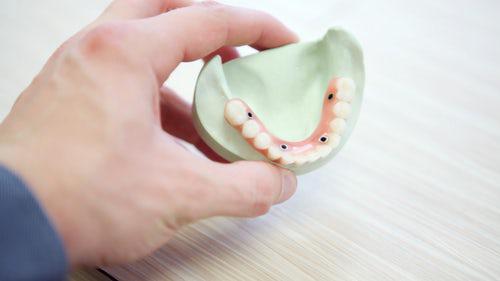 �Implantes dentales o pr�tesis dentales? - Foto