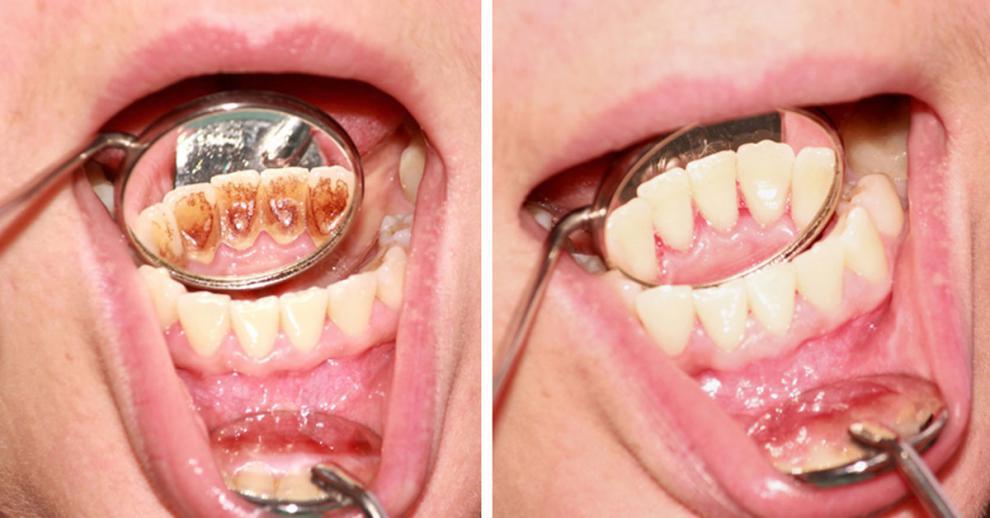 Sarro, caries y enfermedad de las enc�as - Foto