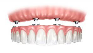 �Implantes dentales para toda la vida? - Foto