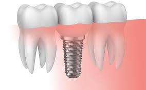 5 mitos sobre los implantes dentales - Foto