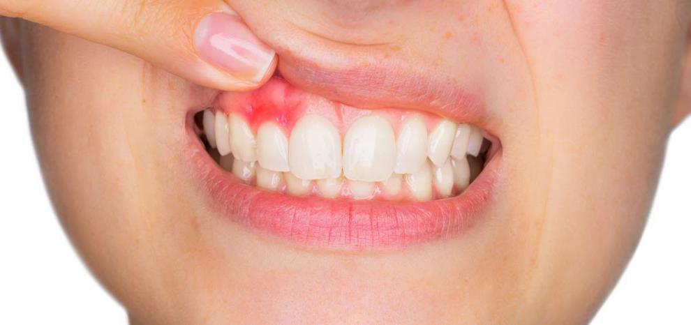 Enc�as inflamadas: �qu� indican? - Foto