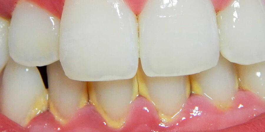 Sarro dental: consecuencias en la salud bucal y prevenci�n - Foto