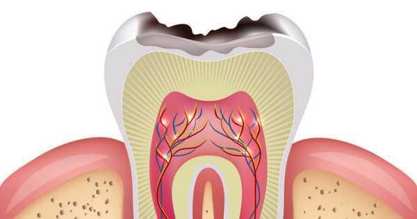 La caries: m�s all� de la dieta y la higiene bucal - Foto