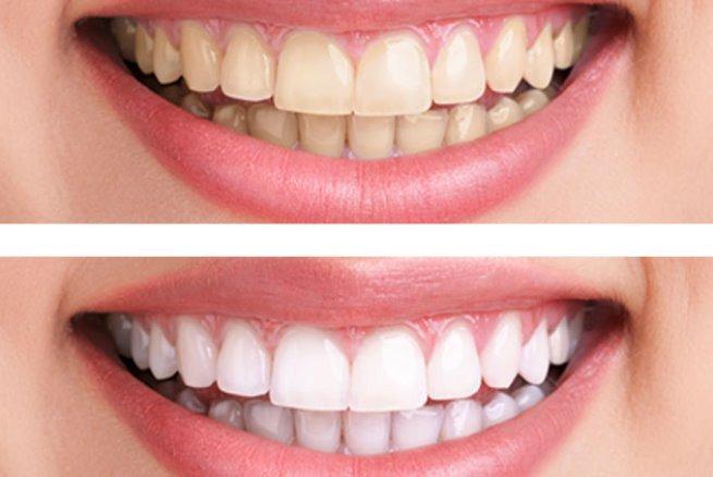 Blanqueamiento dental: c�mo hacer que los resultados duren m�s  - Foto