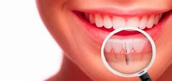 Consejos b�sicos para el cuidado de implantes dentales - Foto