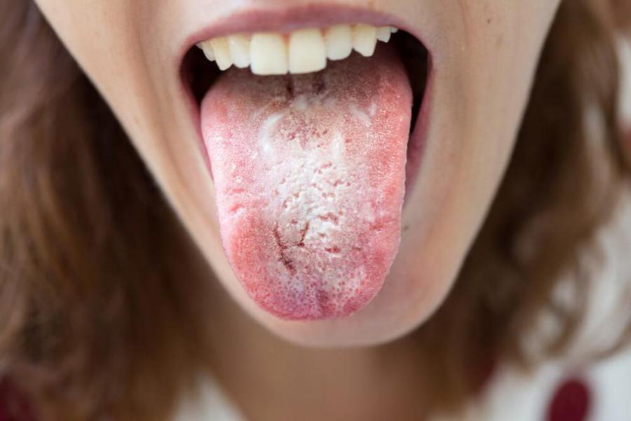 Hongos en la boca: s�ntomas, causas y tratamiento - Foto