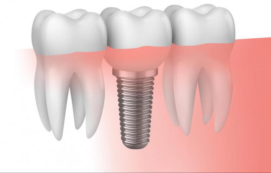 �Qu� es la periimplantitis? - Foto