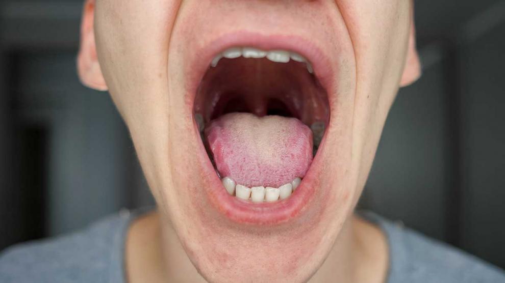C�ncer bucal: causas, s�ntomas y prevenci�n - Foto