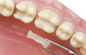 Dientes sensibles tras un empaste dental - Foto