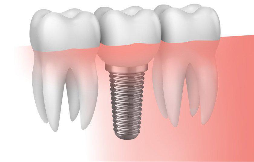 Tres aspectos a tener presentes antes de la colocaci�n de implantes dentales - Foto