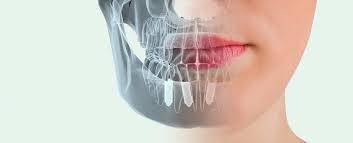 Implantes dentales definitivos: �en qu� consiste este tratamiento? - Foto 2