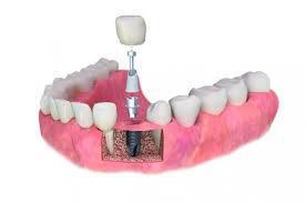 �Por qu� existe tanta diferencia en el coste de los implantes dentales?  - Foto