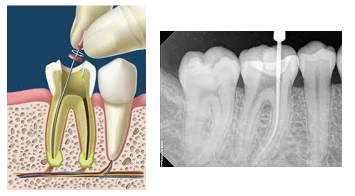 endodoncia
