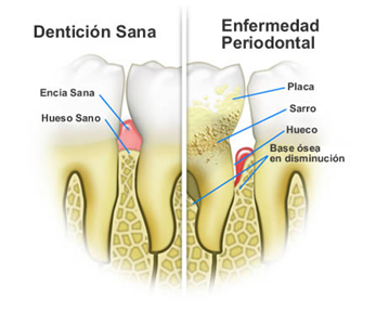 Periodoncia