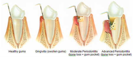 Periodoncia
